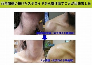 アトピー顔の肌改善法 汗や薬が心配ですか